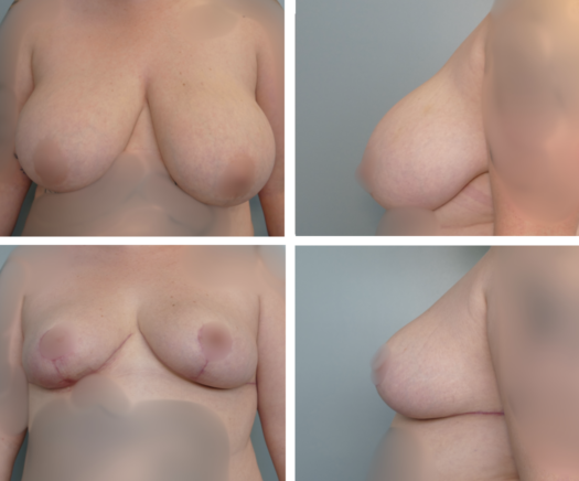 Breast Reduction Portland OR before and after by Dr. Tina Jenq